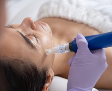 Microneedling
