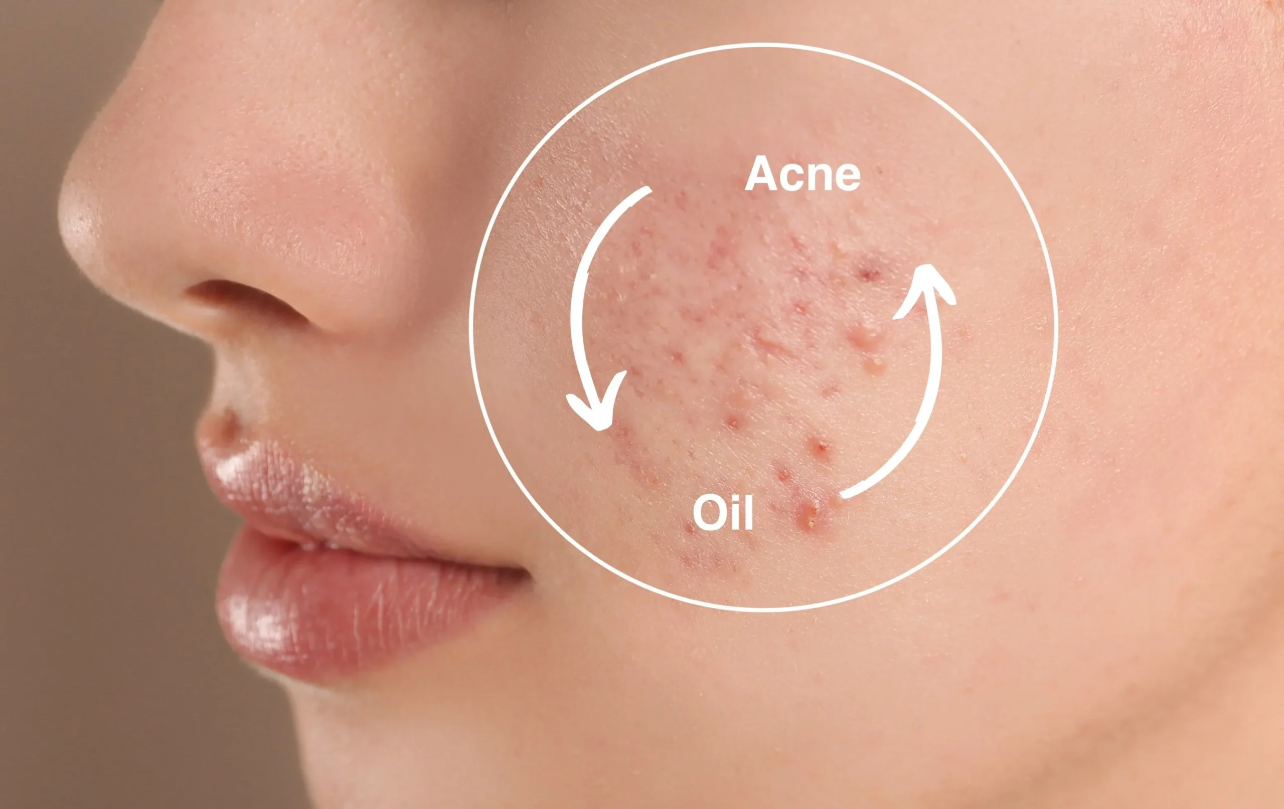 Methods for treating oily and dry Acne-prone skin
