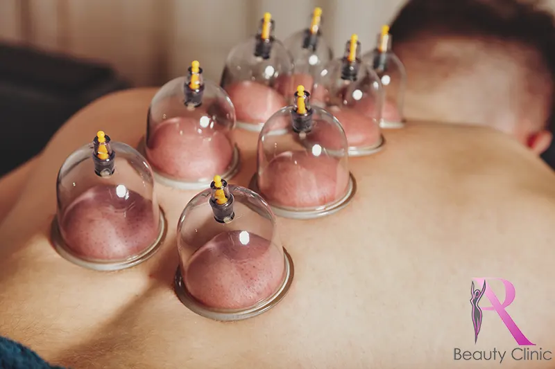 Alles wat je moet weten over cuppingtherapie