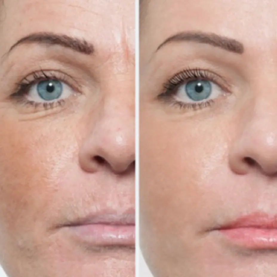 Microneedling Collagen Therapy Amsterdam
