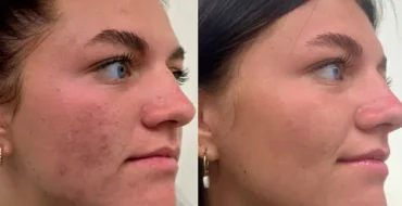 microneedling before after