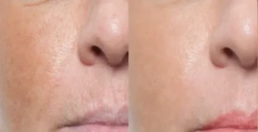 HIFO & microneedling before after