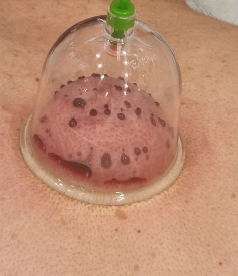 Natte Cupping Behandeling